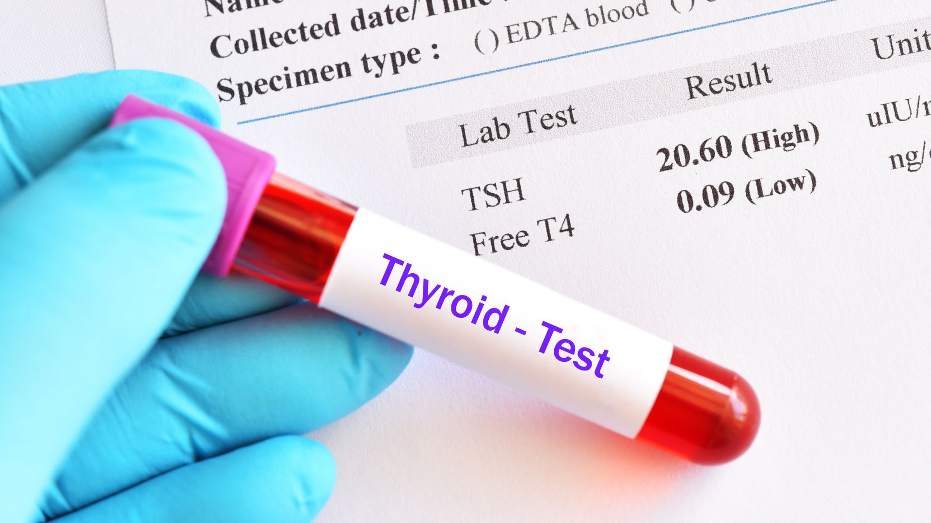 A gloved hand holds a testtube with a Thyroid Test label